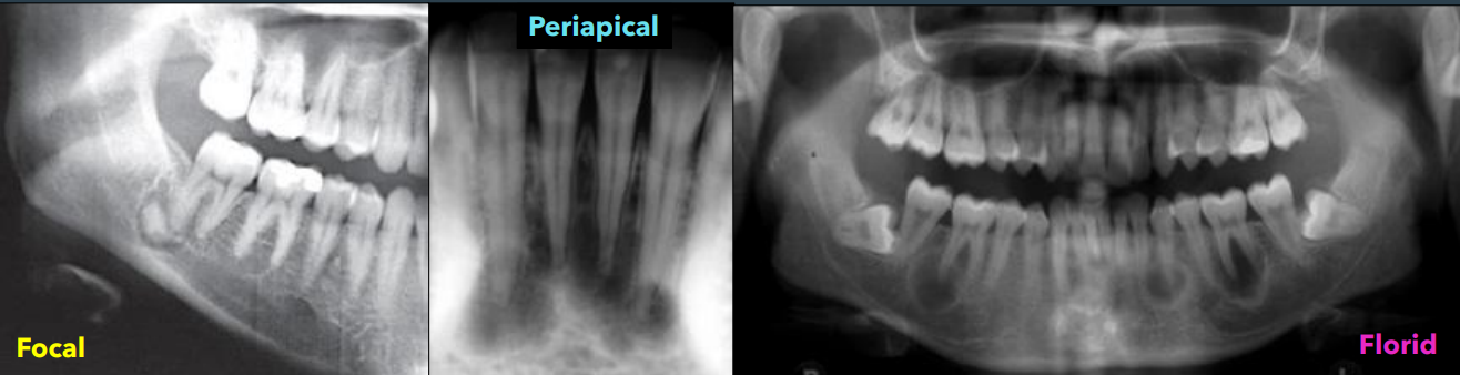 <ul><li><p>focal </p></li><li><p>periapical </p></li><li><p>florid </p></li></ul><p></p>