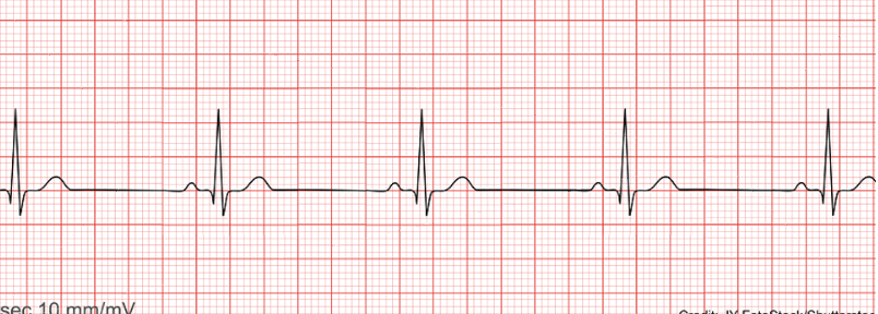 <ul><li><p class=""><strong>Rate</strong>: Less than 60 bpm in the adult (ventricular and atrial)</p></li><li><p class=""><strong>Rhythm</strong>: Regular</p></li><li><p class=""><strong>P waves</strong>: Normal and consistent, in front of the QRS</p></li><li><p class=""><strong>P to QRS Ratio</strong>: 1:1</p></li><li><p class=""><strong>PR Interval</strong>: Consistent, between 0.12 and 0.20 seconds</p></li><li><p class=""><strong>QRS Complex</strong>: Less than 0.12 seconds</p></li></ul><p></p>
