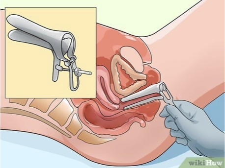 <ul><li><p>Pooling </p><ul><li><p>Sterile speculum inserted into the vagina to evaluate for the presence of amniotic fluid pooling </p></li></ul></li><li><p>Nitrazine paper test</p><ul><li><p>Check pH → (+) if paper turns blue </p></li></ul></li><li><p>Ferning test</p><ul><li><p>Swab collected and evaluated under microscope: (+) if there is a fern like pattern (salt content of amniotic fluid)</p></li></ul></li><li><p>AmniSure</p><ul><li><p>Immunoassay test that detects specific proteins found in amniotic fluid → highly accurate </p></li></ul></li><li><p><strong>Pooling, Nitrazine paper test, and Ferning test usually done together </strong></p></li><li><p>Complications → chorioamnionitis </p></li></ul><p></p><p></p>