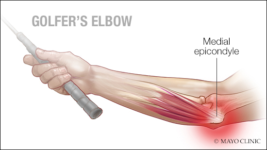 <p>Overuse of *flexor origin* on medial epicondyle → pain during wrist flexion. ⛳ Mnemonic: "Medial = golf deal."</p>