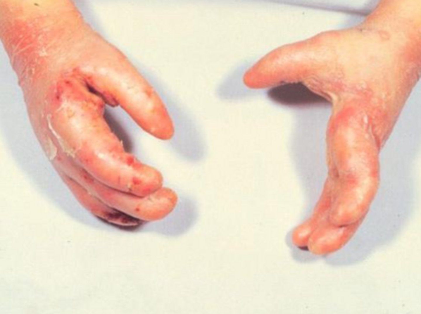 <p>epidermolysis bullosa</p>