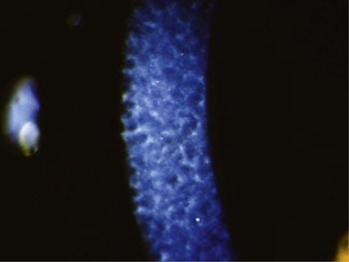 <ul><li><p>epithelial-stromal dystrophy</p></li><li><p>bilateral</p></li><li><p>onset: 1st decade, but not born with corneal signs</p></li><li><p><strong>Symptoms</strong>: more symptomatic than epithelial dystrophies</p><ul><li><p>Visual complaints: blurred vision, photophobia and diplopia</p></li><li><p>Foreign body sensation and pain often due to RCE</p></li></ul></li><li><p><span>less severe then Reis-Bückler</span></p></li><li><p><span><strong>Presentation</strong>: curly fibers on electron microscopy</span></p><ul><li><p><span>Predominantly affects the central cornea</span></p></li><li><p><span>Opacities will be less defined when compared to Reis-Bückler</span></p></li><li><p><span>Opacities will develop in a ring or honeycomb like pattern</span></p></li><li><p><span><em>Will not</em> present with corneal irregularities or decrease corneal sensation</span></p></li></ul></li></ul><p></p>