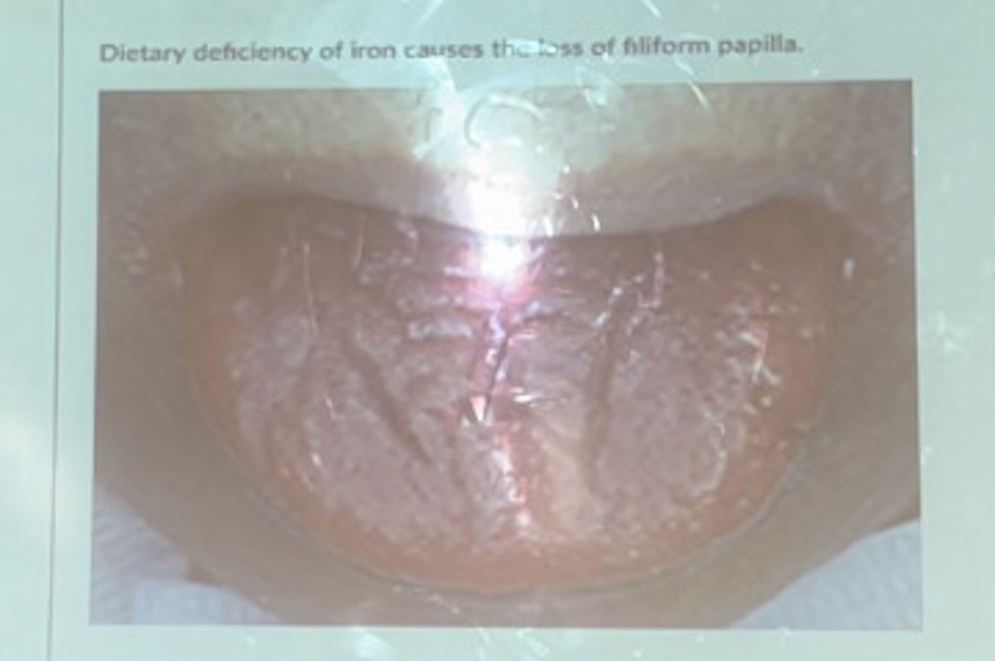 <p>Dietary deficiency of iron causes loss of filliform papilla</p>