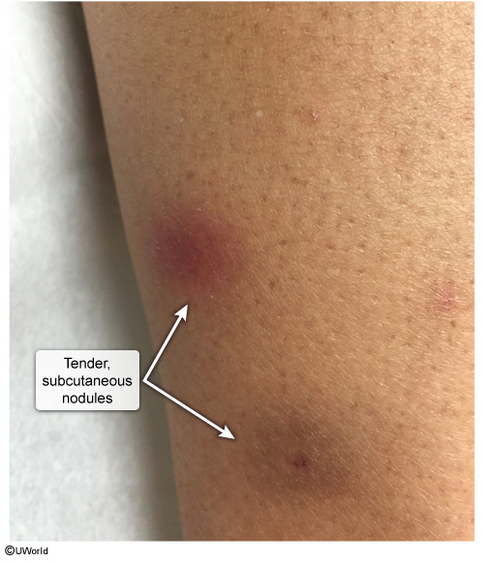 <p>23M w/ rash &amp; diarrhea. what is it &amp; what is the likely underlying association?</p>