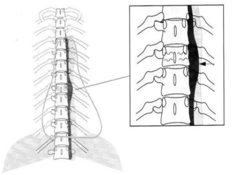<ul><li><p>caused due to haemorrhage </p></li></ul><p></p>