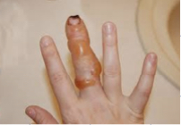 2nd degree burns