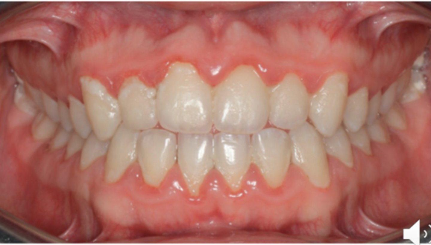 <p>reversible</p><p>- no bone loss</p>