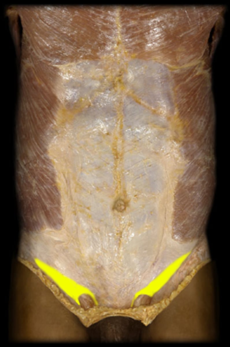 <p>ligament extending from pubic bone to anterior superior iliac spine, forming lower border of abdomen</p>