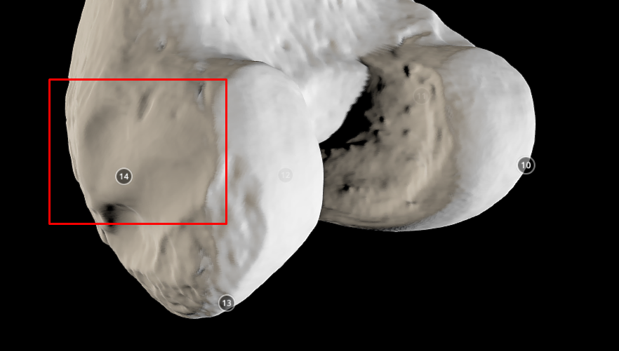 <p>lateral epicondyle (of radius) - above the lateral condyle</p>