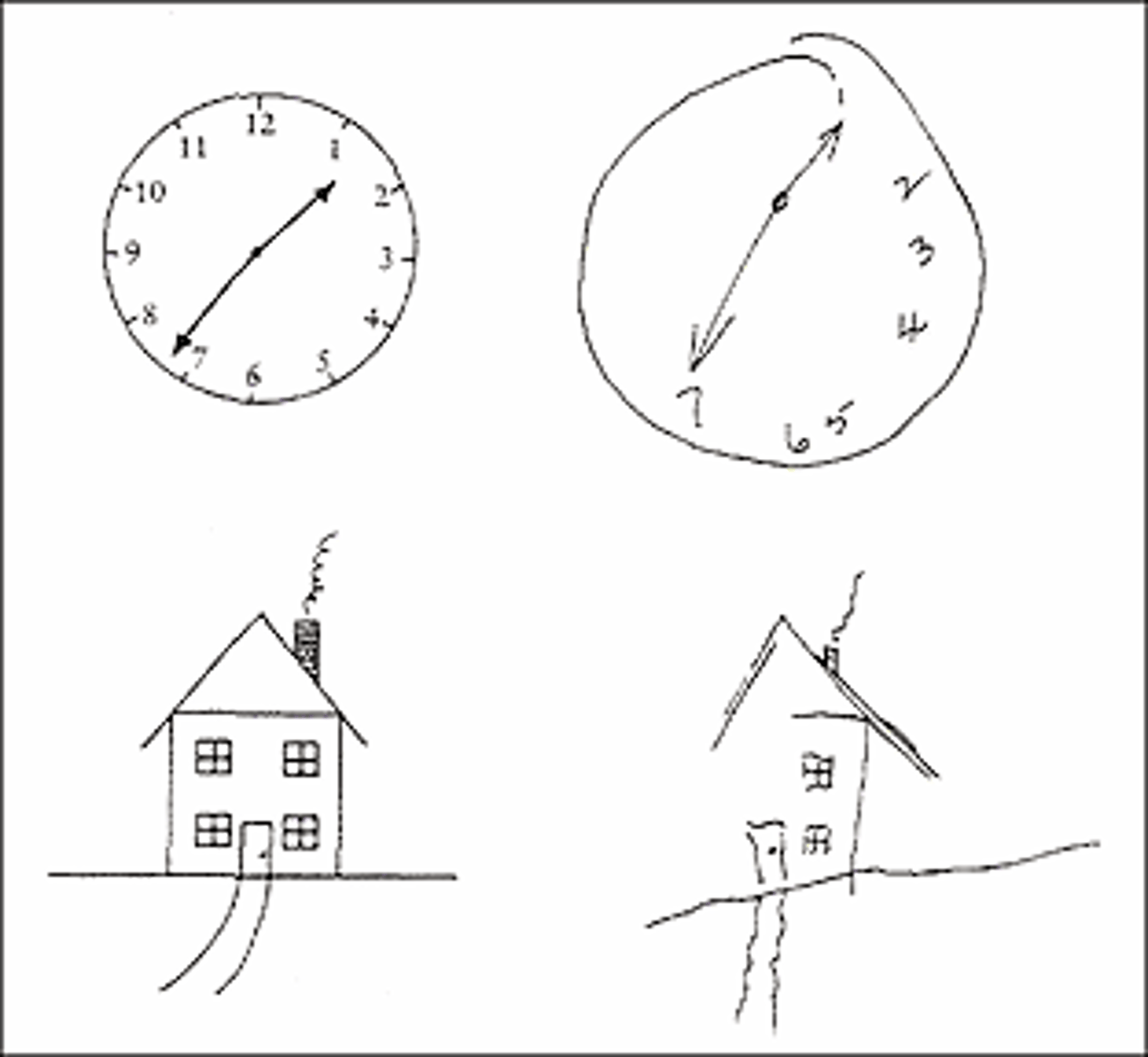 <p>- visuo-spatial coordination deficits<br>- attention deficits<br>- neglect syndromes; hemispatial neglect</p>