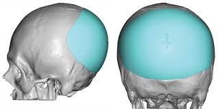 <p>Bulge at lower rear of skull</p>