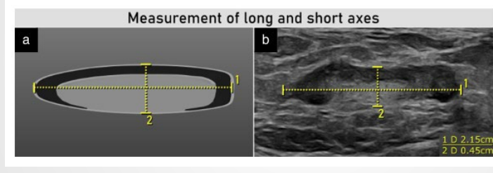 <p>Transverse usually not measured. Long axis and short axis measurement only . AP diameter/short axis most important and should be &lt;1cm if normal</p>