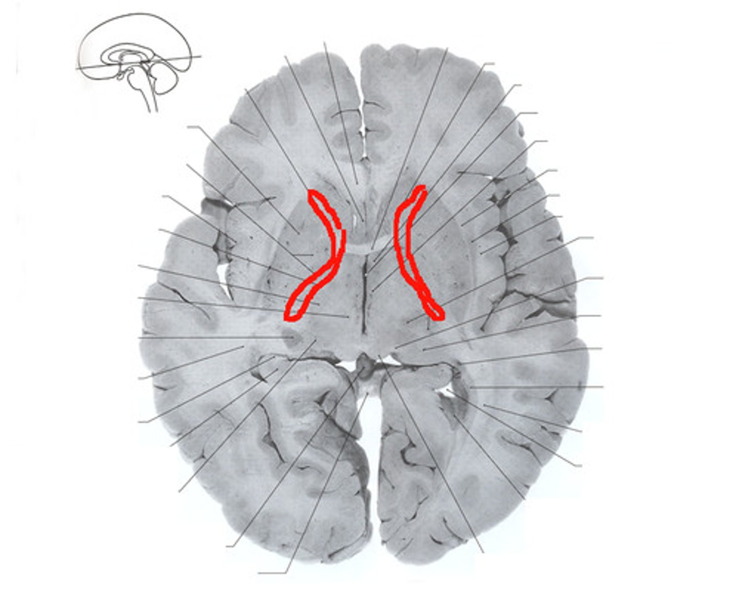 <p>large collection of axons that connects telencephalon with diencephalon</p>
