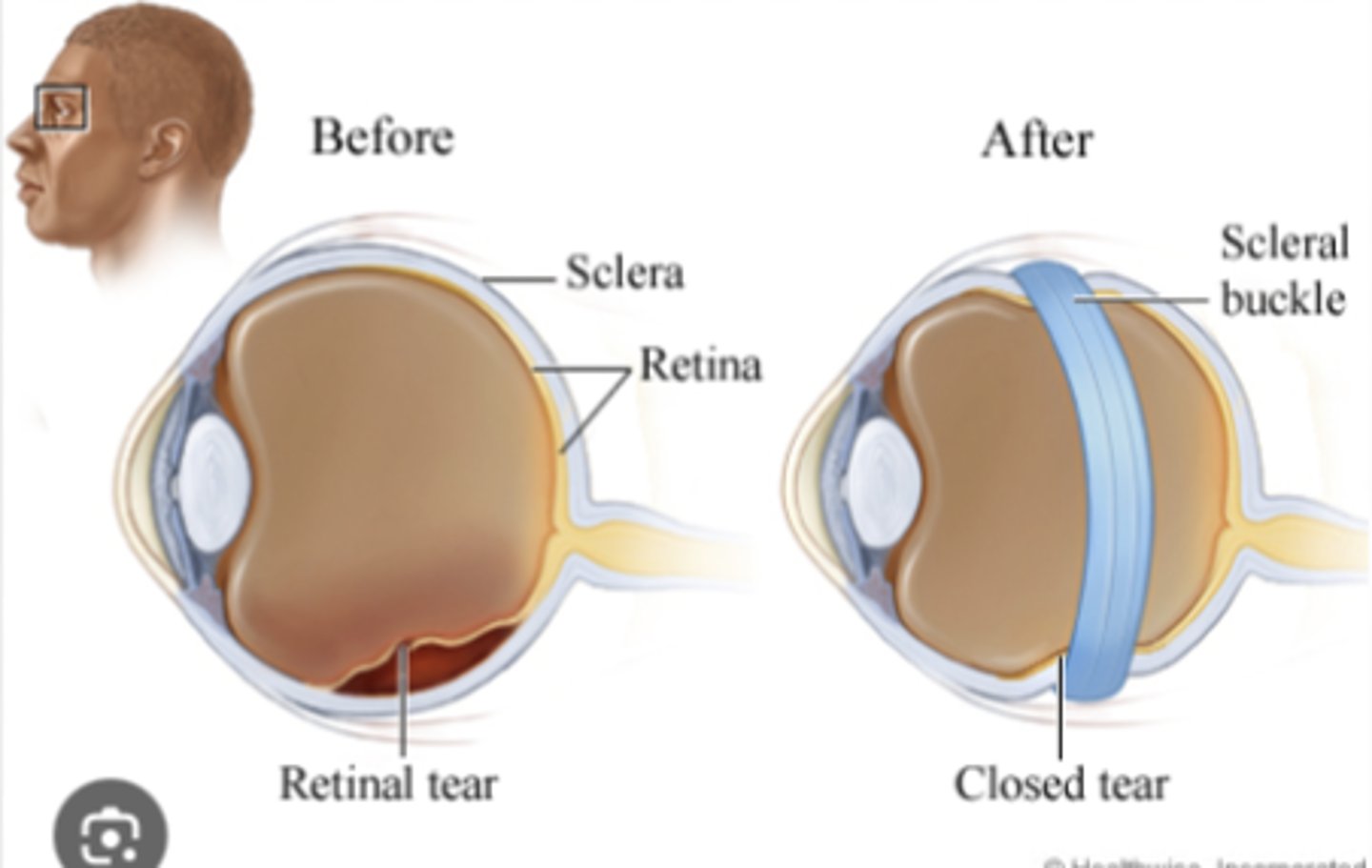 <p>Immediate referral to ophthalmology within 24 hours for laser, cryosurgery, or scleral buckle procedures. The patient should remain supine with the head turned to the side of the detachment.</p>