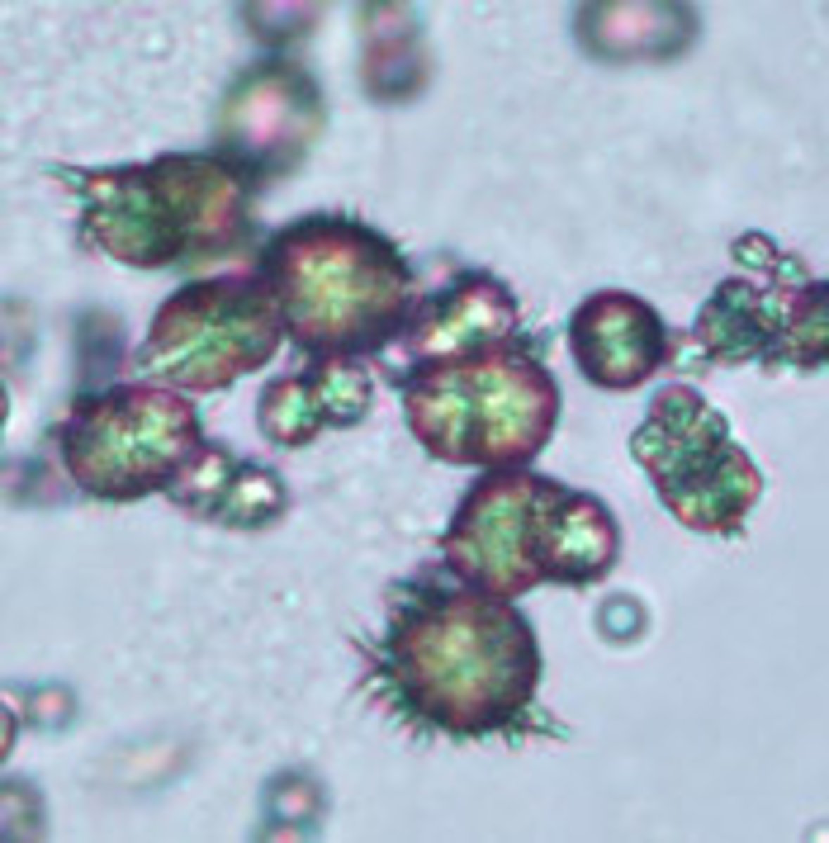 <p>- Brown, three-dimensional spheres</p><p>- Smooth or irregular edges (thorny apple)</p><p>- Seen with liver disease</p>