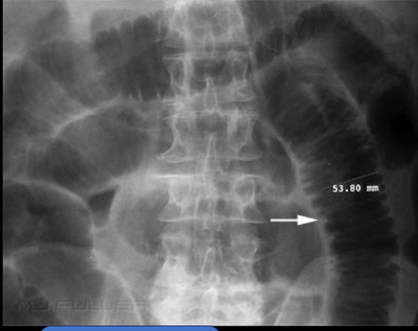 <p>lies centrally, with the large bowel framing it</p><p>mucosal folds are known as valvulae conniventes &amp; are visible across the full width of the bowel</p><p>-3cm wide</p>