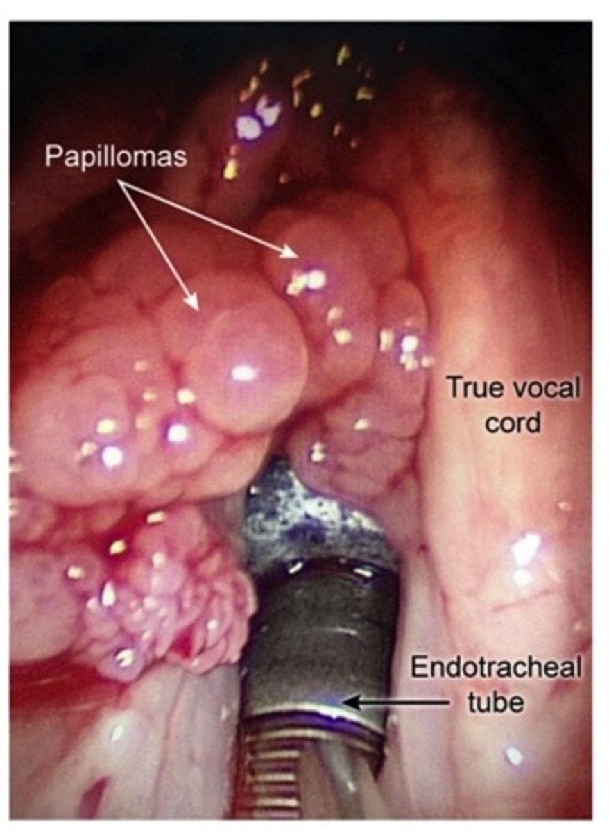 <p>Etiology</p><p>-HPV 6 + 11</p><p>Transmission</p><p>-Vertical direct spread in Infants</p><p>-Sexual contact in adults</p><p>Histo</p><p>-Fibrovascular Core w/ Benign Squamous Cells</p><p>Sx</p><p>-Hoarseness</p><p>-Respiratory distress</p><p>Imaging</p><p>-Verrucous polypoid growths in clusters </p><p>**Must test pt for HIV**</p>