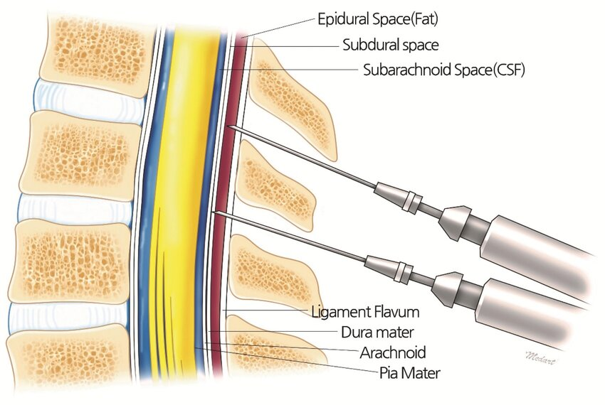 <p>The epidural space, containing fat and internal vertebral venous plexus</p>