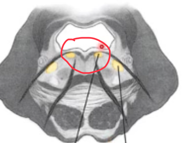 <p>just deep to the facial colliculus</p>
