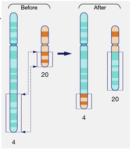 <p>-an exchange of segments between 2 chromosomes (haven’t lost any material)</p><p>-constitutional:</p><p>-prevalence: 1/500-1/1000, ~70% inherited, 30% de novo</p><p>-de novo translocations carry ~6-9% risk of major congenital abnormalitiy</p><p>-most balanced reciprocal translocations have inconspicuous phenotype; significant risk for reproductive problems including infertility, miscarriage, abnormal offspring</p><p>-if a critical gene is at the breakpoint this may influence the phenotype; submicroscopic deletion/duplications may represent cryptic non-balanced </p><p>-somatic:</p><p>-can create fusino genes</p>