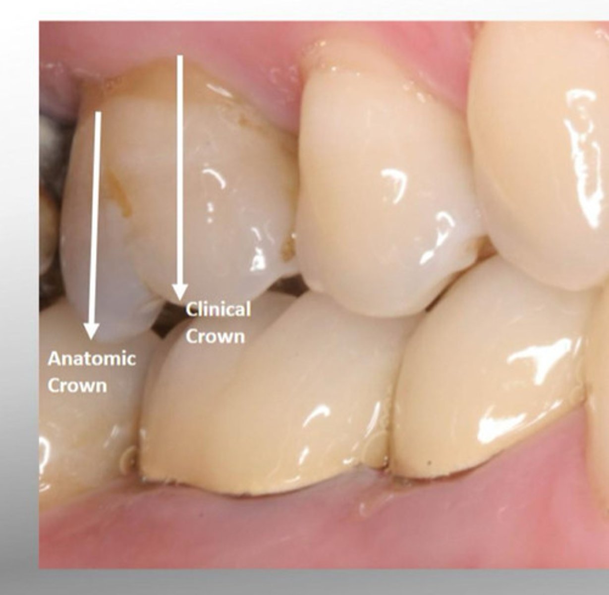 <p>Visible part of tooth</p>