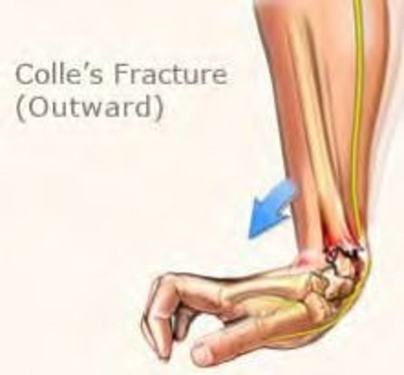 <p>-fracture of the distal radius at the wrist; radius moves palmarly<br>-extension fracture</p>