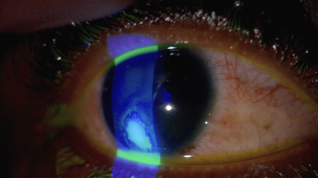 <p>43 y/o female presents to the ED for eye pain - she says, “I think something is stuck up in there.” She wears contacts. Fluorescein stain reveals a ROUND spot that picks up the dye. What is your treatment plan?</p>