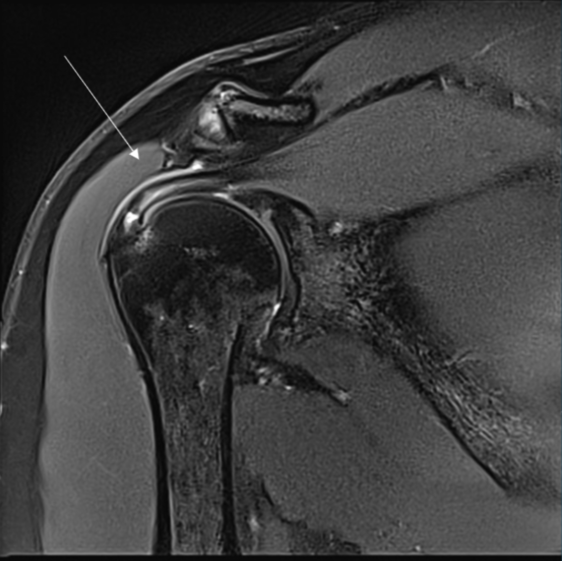 <p>Describe the pathology indicated by the arrow (Cor T2 FS). </p>