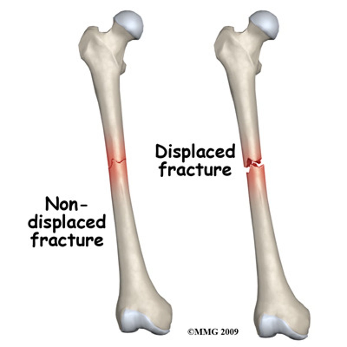 <p>Bone ends stay in normal position</p>