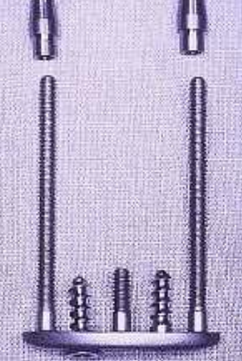 <p><span><span>What type of surgical approach is required for transosseous implants?</span></span></p>