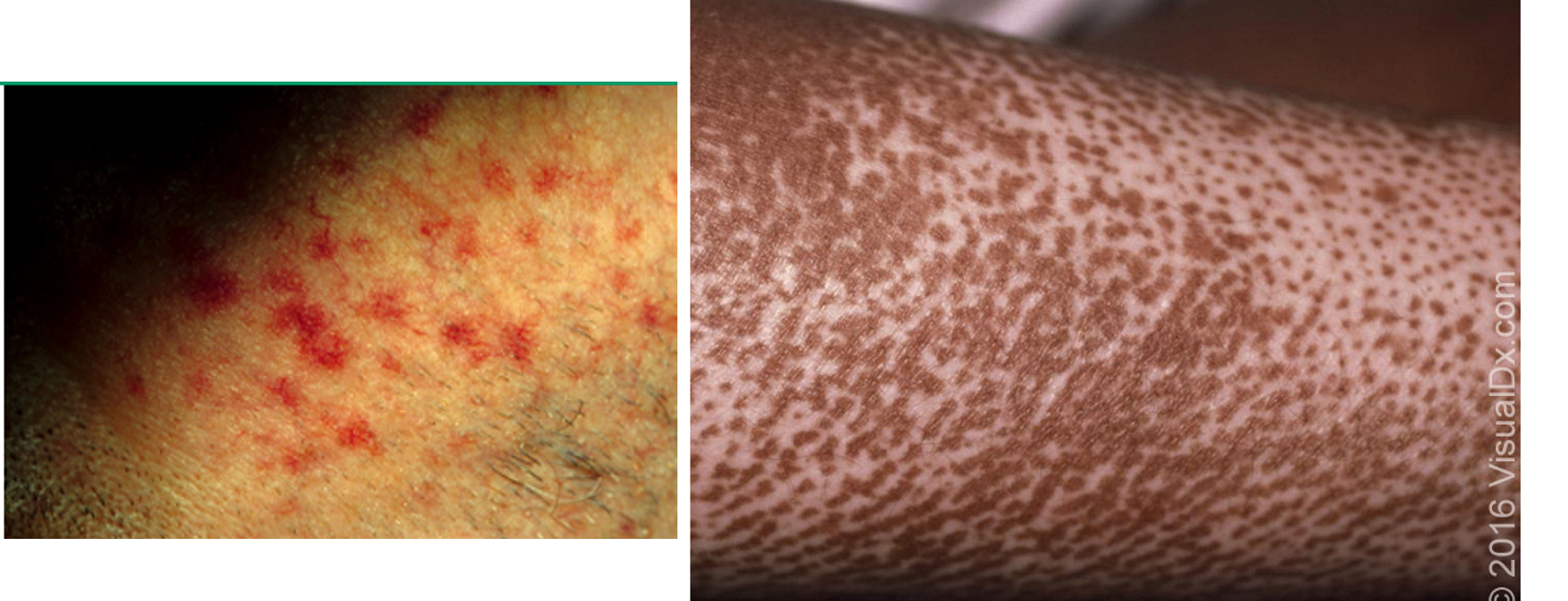 <ul><li><p>pruritus and <strong>edema</strong> in early stages</p></li><li><p>skin hyperpigmentation or depigmentation</p></li><li><p>dry skin, <strong>skin thickening/hardening</strong></p></li><li><p><strong>Raynaud phenomenon</strong></p></li><li><p><strong>painful ulcerations at DIP/PIP</strong> ; “rat bite necrosis”</p></li><li><p><strong>sclerodactyly</strong> w/ tapering of fingers→ loss of distal phalanges</p></li><li><p>loss of sweat glands, anhidrosis</p></li><li><p>calcinosis cutis</p></li><li><p>early face changes→ periorbital edema</p></li><li><p>late face changes → edema and fibrosis result in loss of normal facial line, mask like thinning of lips, beak like sharp nose</p></li></ul><p></p>