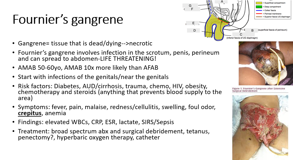 <p>true! <br><br><strong>Hyperbaric oxygen therapy</strong> helps in <strong>Fournier's gangrene</strong> by <strong>improving oxygen delivery</strong>, inhibiting the growth of anaerobic bacteria, enhancing the immune response, and promoting wound healing. This can significantly <strong>increase survival rates</strong> and <strong>reduce morbidity</strong> when used in conjunction with <strong>surgical debridement</strong> and appropriate <strong>antibiotics</strong>.<br></p>