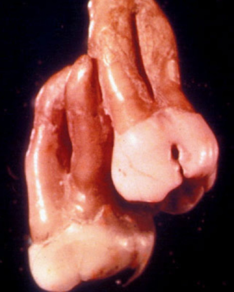 <p>Union of root structure of two or more teeth by cementum, can occur during root formation</p>