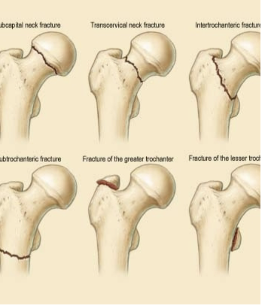 <p><strong>Review femur fx descriptions</strong></p>