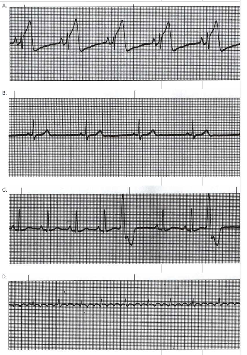 <p>Choose the Rhythm Strip which would indicate a myocardial infarction as occurre</p>
