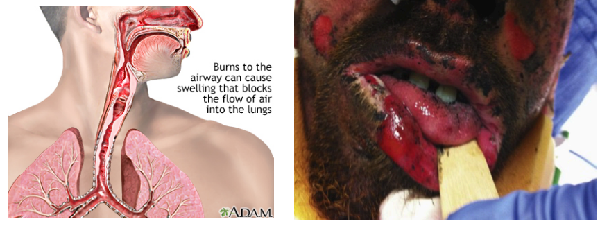 <ul><li><p>Facial burn</p></li><li><p>Singed nasal burn</p></li><li><p>Harsh cough</p></li><li><p>Hoarseness</p></li><li><p>Abnormal breath sounds</p></li><li><p>Respiratory distress</p></li><li><p>Carbonaceous sputum — black sputum</p></li><li><p>Hypoxemia</p></li></ul><p></p>