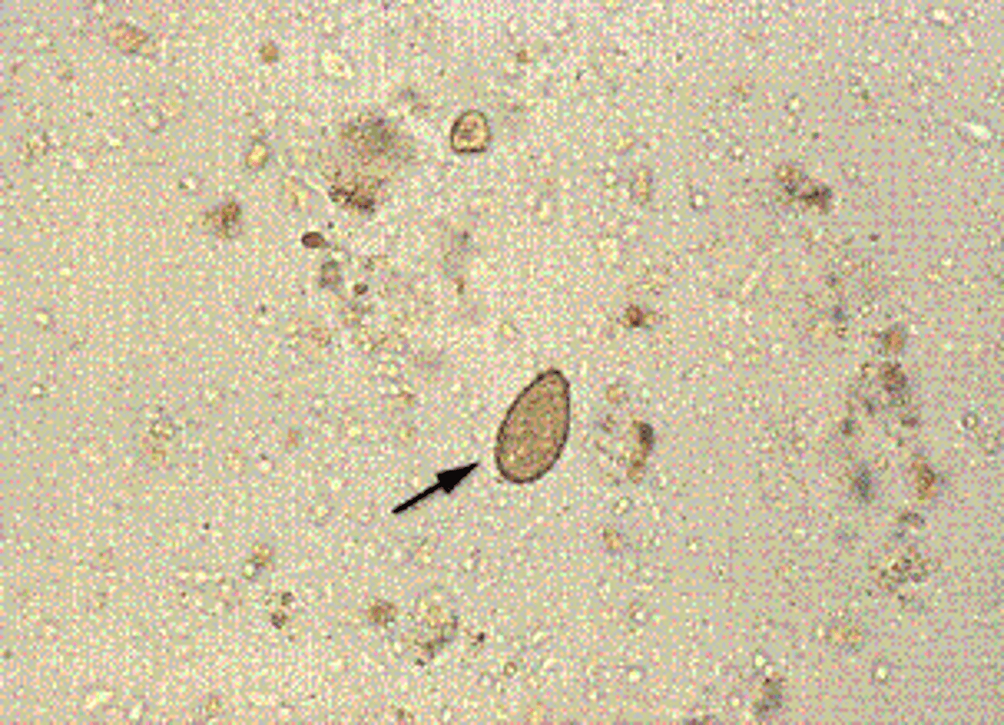 <p>b.Clonorchissinensis.</p><p>The Chinese liver fluke, Clonorchis (Opisthorchis) sinensis, is geographically limited to the Far East, where dogs and cats serve as reservoir hosts. The adults live in the distal bile ducts. Repeated or heavy infections cause inflammation because of mechanical irritation, fever, diarrhea, pain, fibrotic changes, or obstruction of the bile duct. The diagnosis is made by finding the egg in a stool specimen. The egg is 29 to 35 μm long, embryonated when passed, flash shaped, and operculated with prominent shoulders at the operculum and a knob at the opposite end. </p>