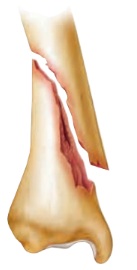 <p>fracture</p>