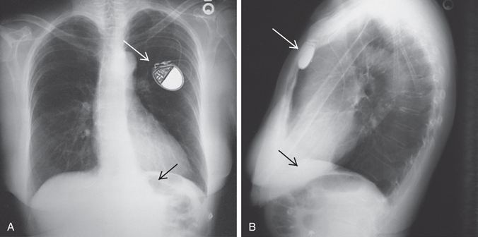 <p>Internal: surgically implanted; External: temporary, placed post-surgery or for testing.</p>