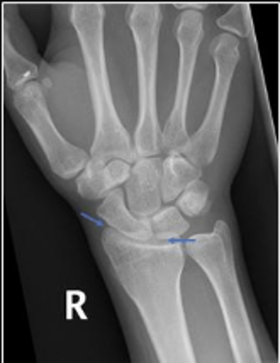 <p>What joint space are the arrows pointing to?</p>