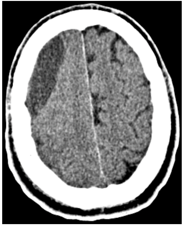 <p>What does this CT image show?</p>