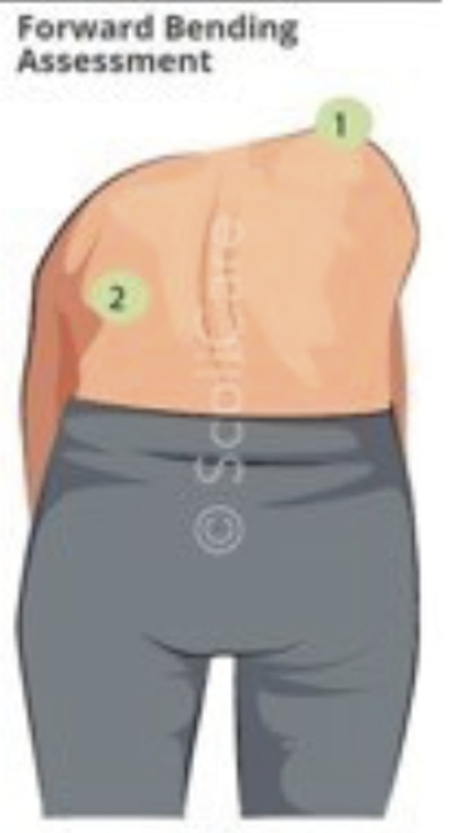 <p>- diagnosis: scoliosis</p><p>- how: ask patient to bend forward &amp; touch toes, observe from behind</p><p>+ = scapular prominence</p>