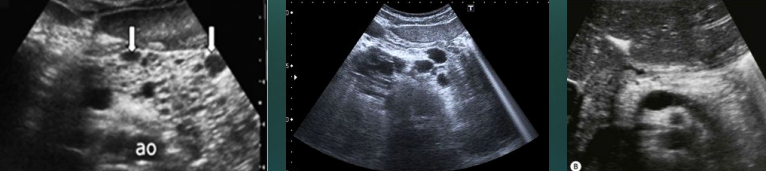 <p><span style="color: yellow;">Makes pancreas</span> <span style="color: yellow;">hyperechoic and small</span></p><p>Hypoechoic areas can represent pancreatic fibrosis</p><p><span style="color: yellow;">Small cysts/calcifications, gallstones, liver disease associated with CF</span></p>