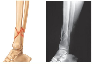 <p>Bone fragments into three or more pieces. Particularly common in the aged, whose bones are more brittle.</p>