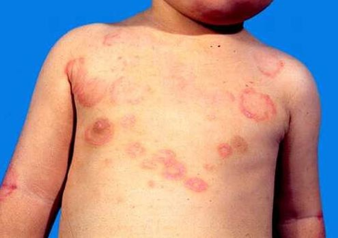 <p>5 major-> arthritis, carditis, CNS(chorea), subQ nodules, erythemia marginatum</p><p>4 minor-> arthralgia, fever, elevated ESR/CRP, prolonged PR</p>
