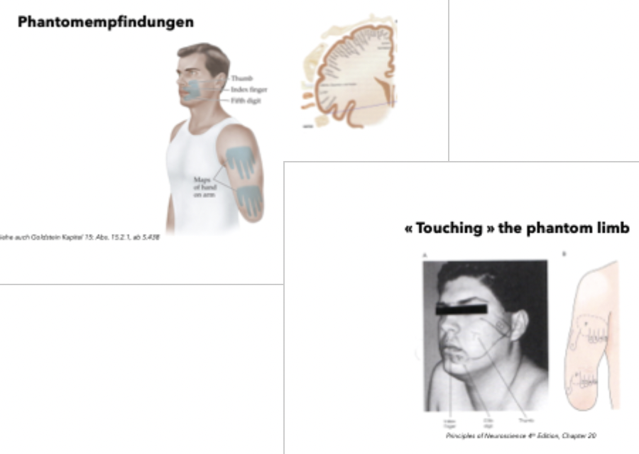 <p class=""><strong>Kurzfassung:</strong><br>Nach einer Amputation kann das <strong>Gesichtsareal im somatosensorischen Kortex</strong> die <strong>ehemaligen Handareale übernehmen</strong>, was dazu führt, dass <strong>Berührungen im Gesicht als Phantomempfindungen in der fehlenden Hand</strong> wahrgenommen werden.</p><div data-type="horizontalRule"><hr></div><p class=""><strong>Langfassung:</strong></p><ul><li><p class=""><strong>Beobachtung:</strong></p><ul><li><p class="">Patient empfindet Berührung im <strong>Gesicht</strong> (z. B. Wange, Kiefer) als Berührung in der <strong>amputierten Hand</strong> (z. B. Daumen, kleiner Finger)</p></li></ul></li></ul><p class=""></p><ul><li><p class=""><strong>Neurophysiologische Erklärung:</strong></p><ul><li><p class="">Im <strong>somatosensorischen Kortex</strong> sind <strong>Gesicht und Hand benachbart</strong> repräsentiert</p></li><li><p class="">Nach der Amputation wird das <strong>ehemalige Handareal nicht mehr stimuliert</strong></p></li><li><p class="">Das benachbarte <strong>Gesichtsareal dehnt sich plastisch aus</strong> und übernimmt die verwaisten Handregionen</p></li></ul></li></ul><p class=""></p><ul><li><p class=""><strong>Folge:</strong></p><ul><li><p class="">Berührungen im Gesicht <strong>aktivieren versehentlich</strong> das frühere Handareal</p></li><li><p class="">Das Gehirn <strong>interpretiert</strong> dies fälschlich als Reiz von der <strong>nicht mehr vorhandenen Hand</strong></p></li></ul></li></ul><p class=""></p><ul><li><p class=""><strong>Bedeutung:</strong></p><ul><li><p class="">Beleg für <strong>kortikale Reorganisation und neuronale Plastizität</strong></p></li><li><p class="">Veranschaulicht, wie das Gehirn auf <strong>Verlust sensorischer Eingänge</strong> adaptiv reagiert</p></li></ul></li></ul><p></p>