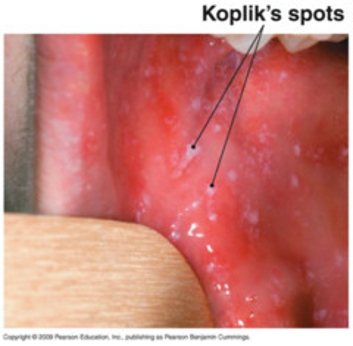 <p>-starts with a fever, conjunctivitis, fatigue, cough, runny nose, red eyes, and a sort throat</p><p>-Koplik spots (tiny white spots) in the mouth before the rash starts</p><p>-red or reddish brown rash beginning on the face then spreads downwards</p><p>-spike in fever with rash</p>