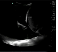 <p>What does fibrinous tissue w/in the anechoic free fluid indicate?</p>