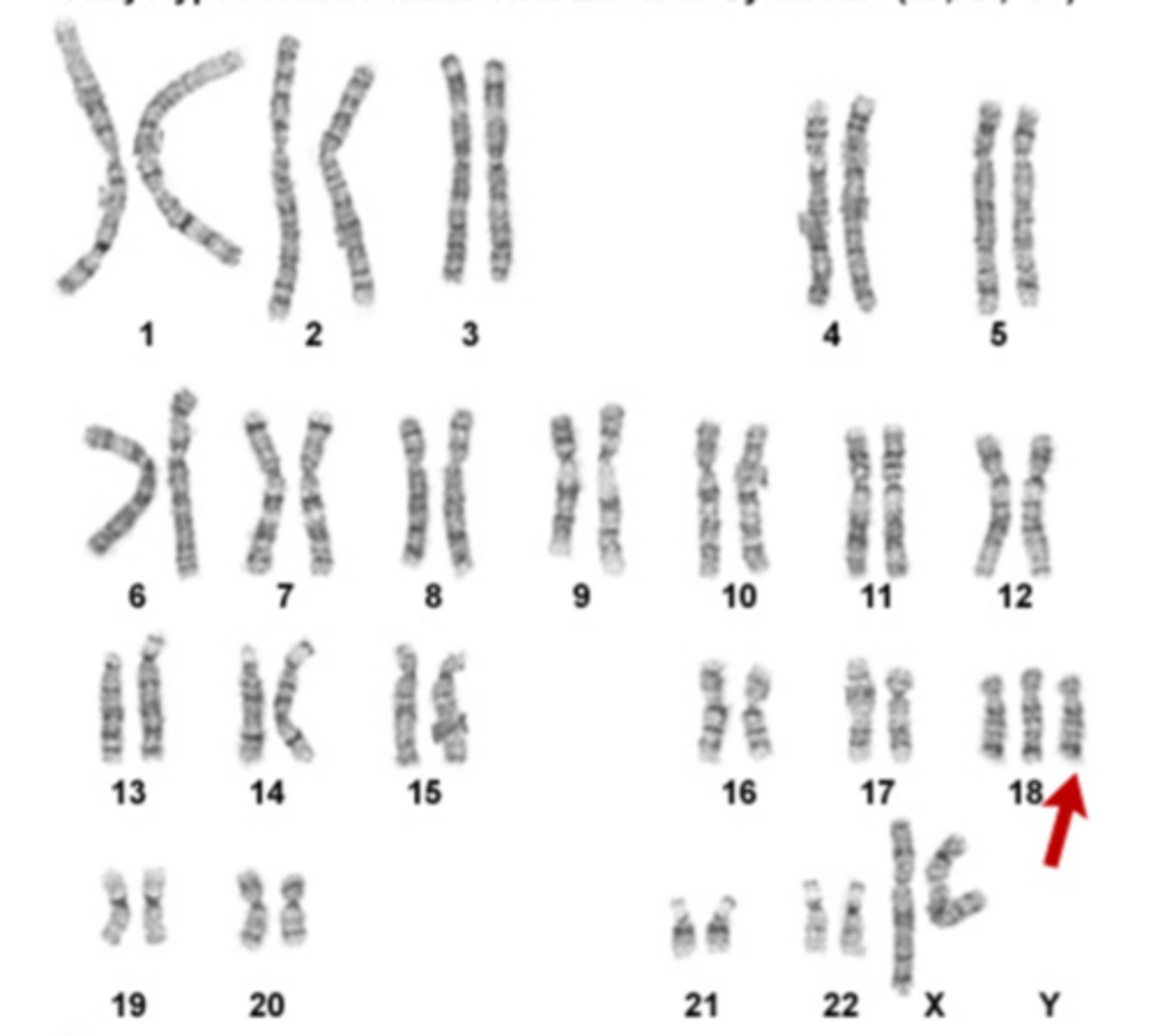 <p>A genetic disorder in which three copies of chromosome 18 are inherited; affects 1 out of every 5000 live-born infants; only 5- 10% of children with syndrome live past the first year; more common in pregnancy but most die before birth; 3x more common in girls than boys; Associated with abnormalities in many parts of the body; babies that survive have severe intellectual disabilities; experience slow growth before birth, low birth weight, heart defects; symptoms also include small abnormal shaped head, a small jaw and mouth, clenched fists with overlapping fingers</p>