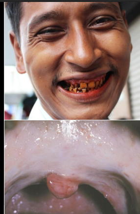 <p>trismus, fibrous bands (buccal, soft palate), stomatopyrosis (general oral burning from spicy food) </p>